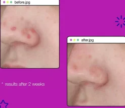 DermalogicaClear Start Post-Breakout Fix 15 ml