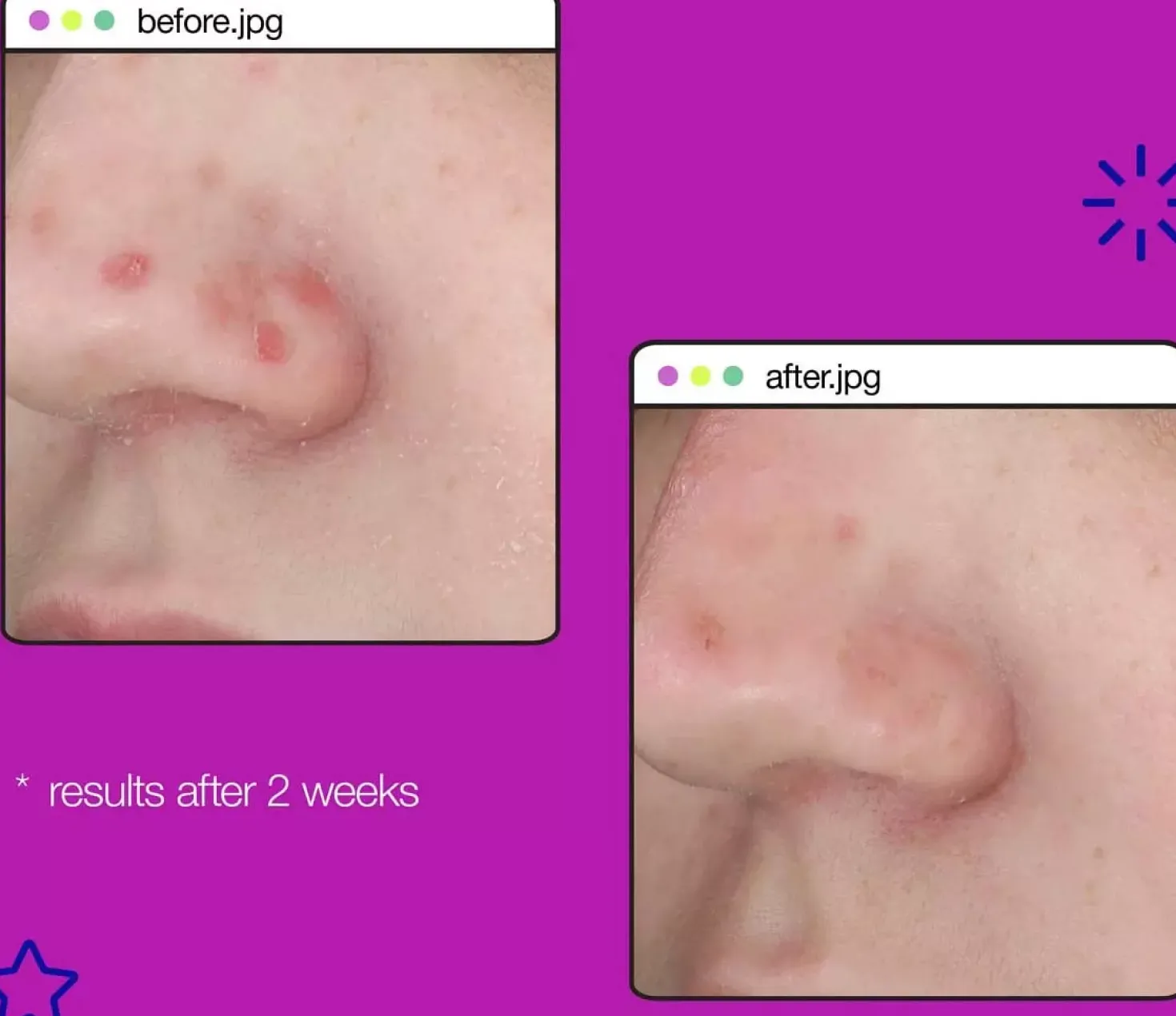 DermalogicaClear Start Post-Breakout Fix 15 ml
