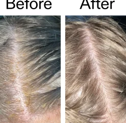 The Inkey List Salicylic Acid Exfoliating Scalp Treatment 150 ml